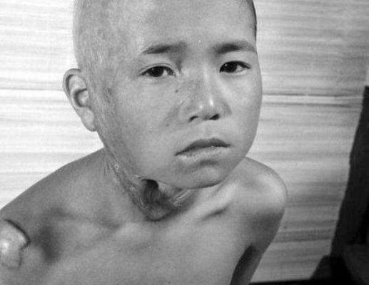 核辐射到底会把人变成什么样？